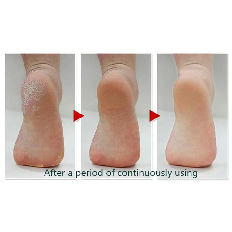 Perfect Pedi Callus Remover – Ultimate Foot Care Tool | Ideal Gift for Moms, Athletes & Seniors